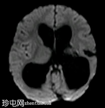 导水管狭窄