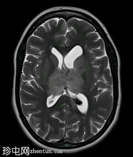 双丘脑静脉梗塞