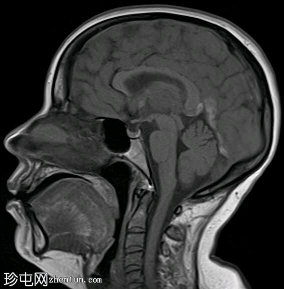 双丘脑静脉梗塞