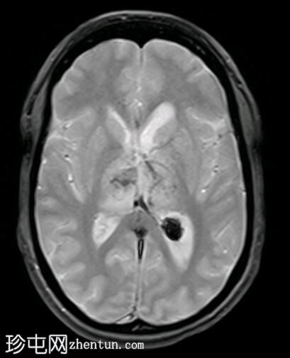 双丘脑静脉梗塞