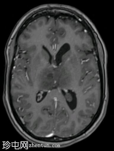 双丘脑静脉梗塞
