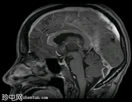 双丘脑静脉梗塞