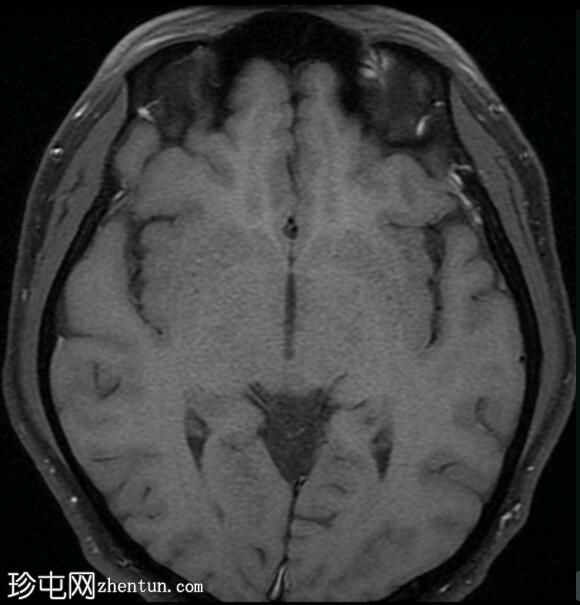 小脑桥脑角星形细胞瘤