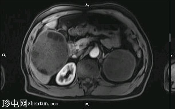 肝肾包虫囊肿