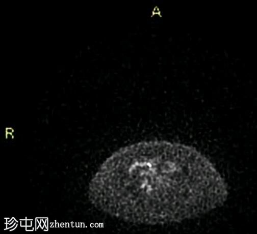 胰岛素瘤