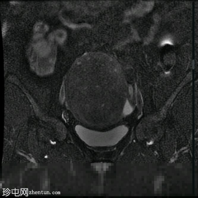 局灶性子宫腺肌病（MRI）