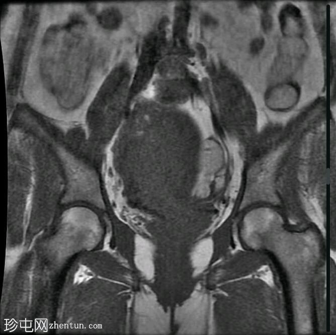 局灶性子宫腺肌病（MRI）