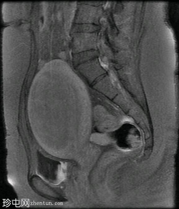 局灶性子宫腺肌病（MRI）