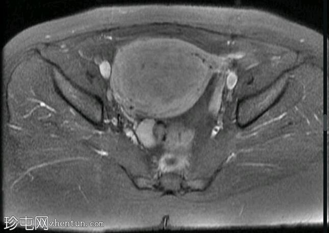 局灶性子宫腺肌病（MRI）