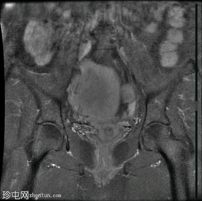 局灶性子宫腺肌病（MRI）