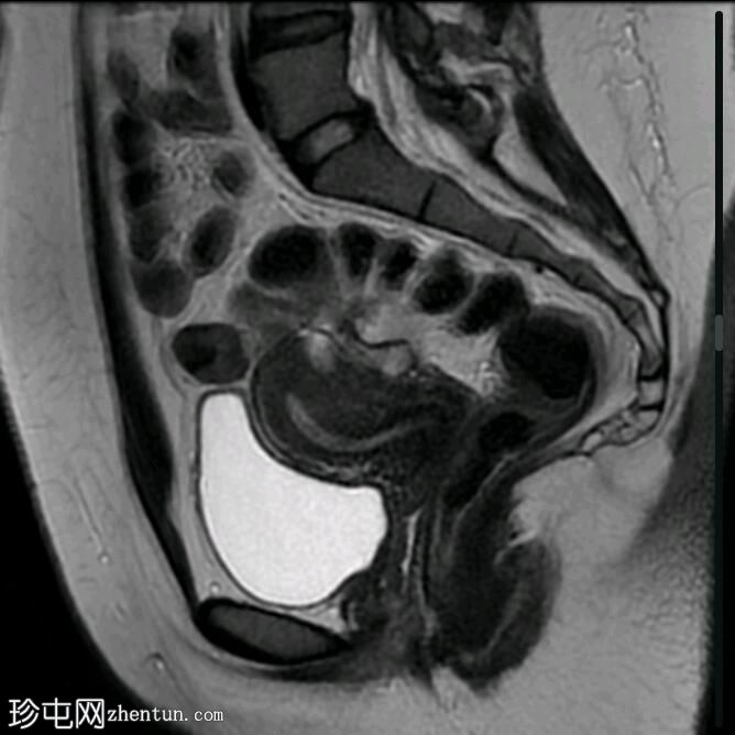 双侧卵巢子宫内膜异位症、输卵管积血和盆腔深部子宫内膜异位症