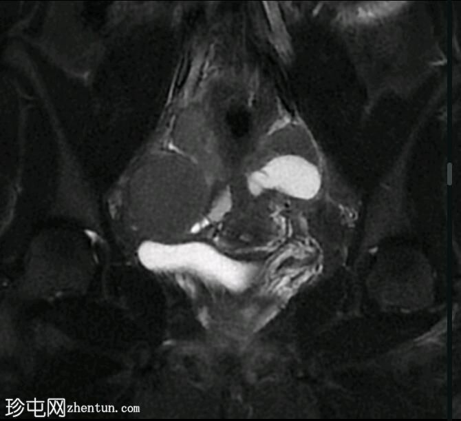 双侧卵巢子宫内膜异位症、输卵管积血和盆腔深部子宫内膜异位症