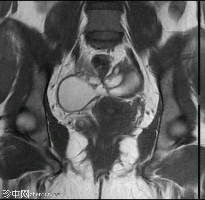 双侧卵巢子宫内膜异位症、输卵管积血和盆腔深部子宫内膜异位症