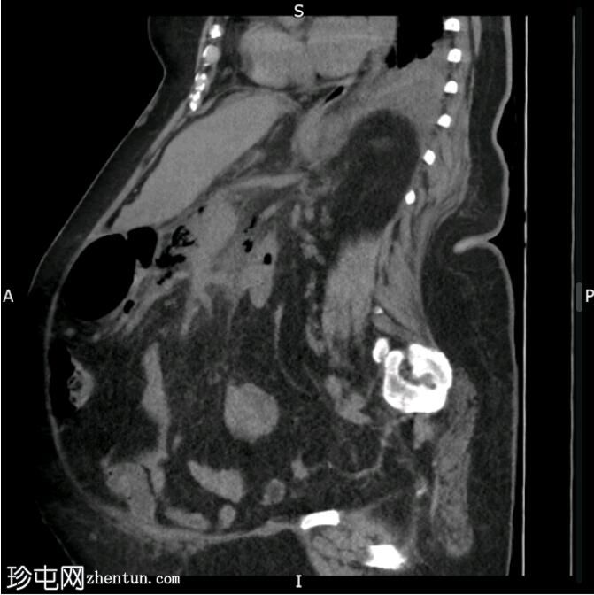 气肿性坏死性胰腺炎