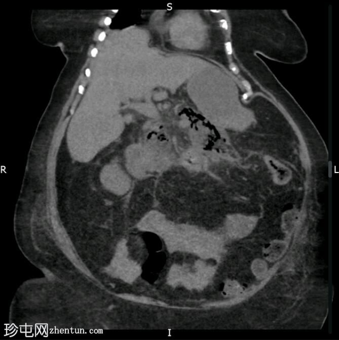 气肿性坏死性胰腺炎