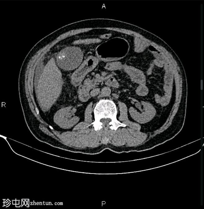 转移性胆囊腺癌