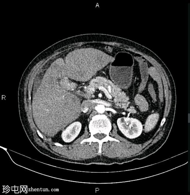 转移性胆囊腺癌