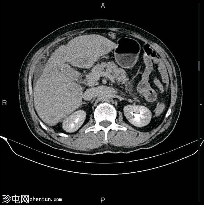 转移性胆囊腺癌